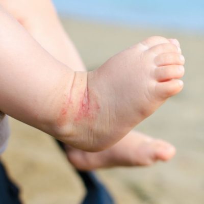 Eczema ~ Causes and Natural Treatments